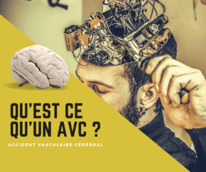 Implant cérébral - Neurosciences